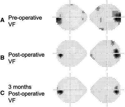 Case Report: Atypical visual presentation caused by a large convexity meningioma—a nerve stretching and stalk indentation effect